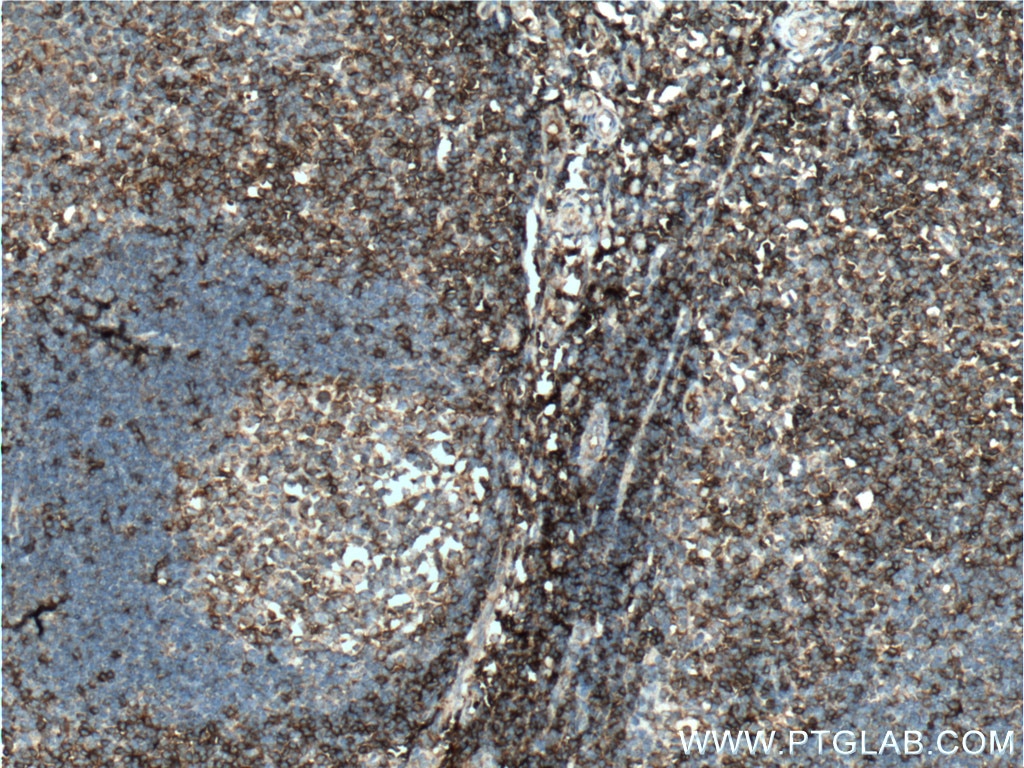 Immunohistochemistry (IHC) staining of human tonsillitis tissue using CD3 Gamma Polyclonal antibody (21120-1-AP)