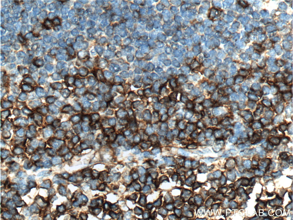 Immunohistochemistry (IHC) staining of human tonsillitis tissue using CD3 Gamma Polyclonal antibody (21120-1-AP)