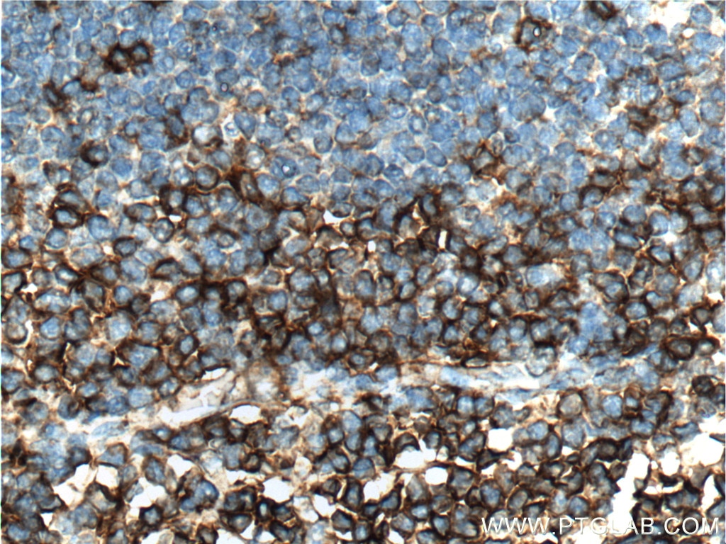 IHC staining of human tonsillitis using 21120-1-AP