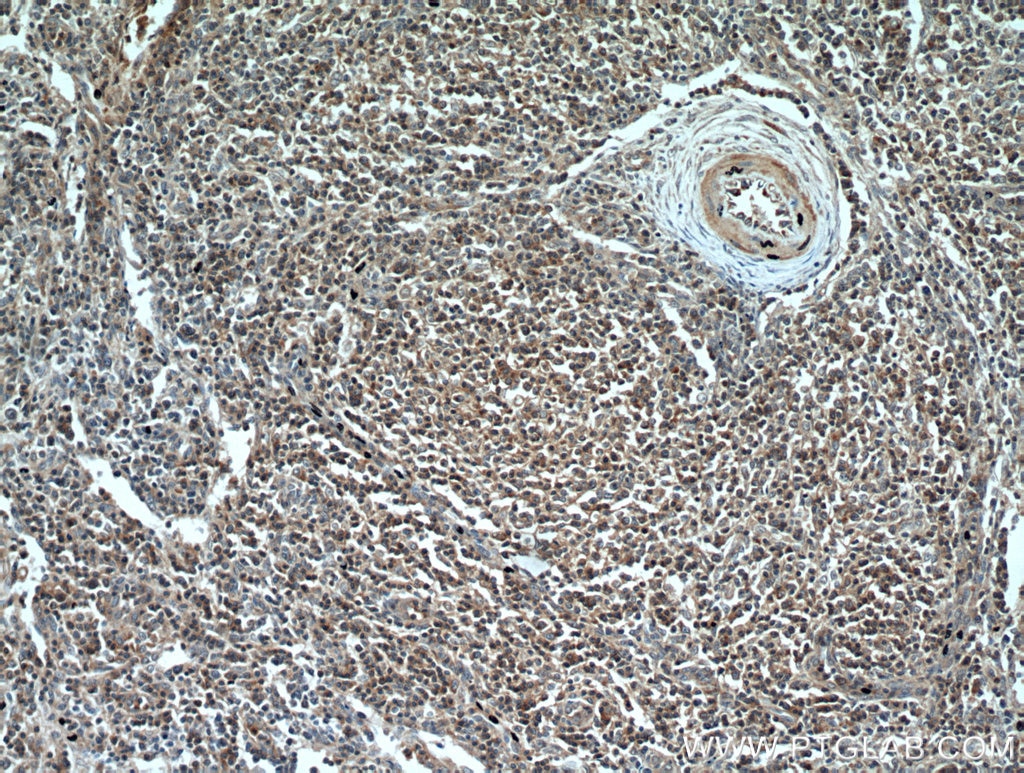 Immunohistochemistry (IHC) staining of human lymphoma tissue using CD3 Gamma Polyclonal antibody (21120-1-AP)