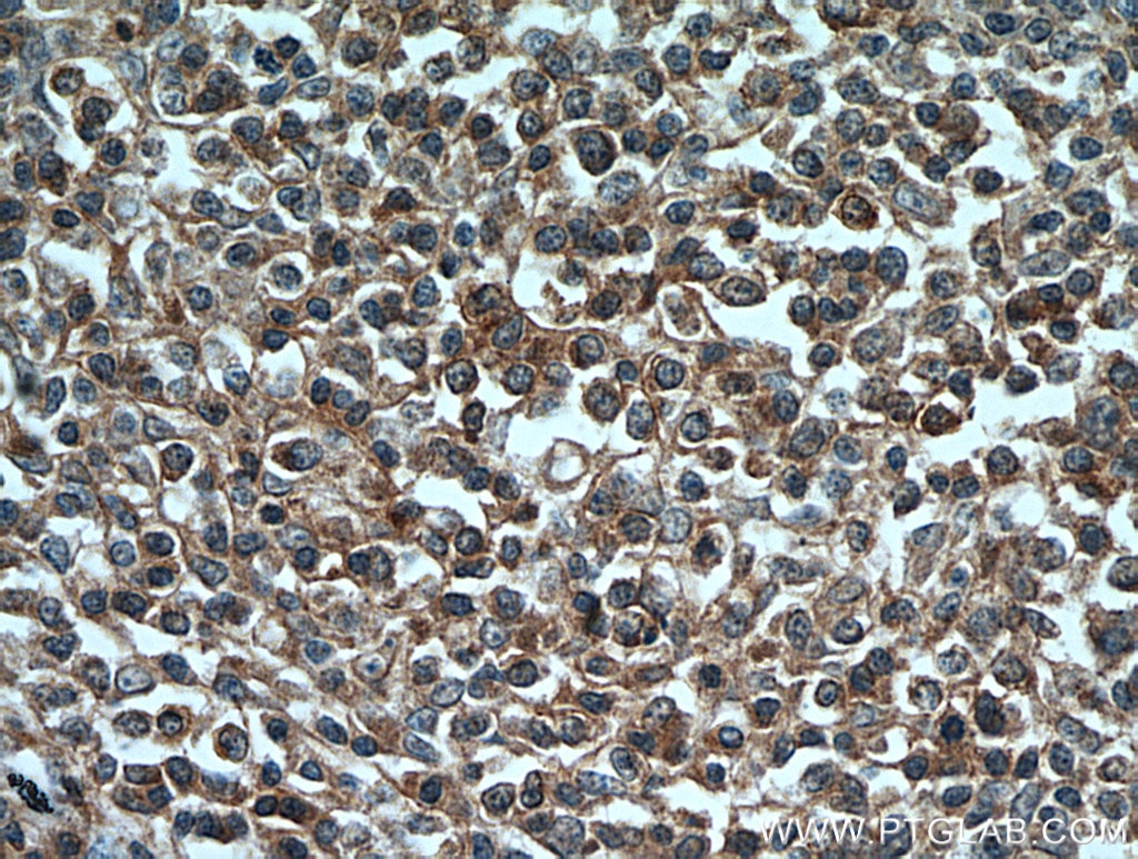 Immunohistochemistry (IHC) staining of human lymphoma tissue using CD3 Gamma Polyclonal antibody (21120-1-AP)