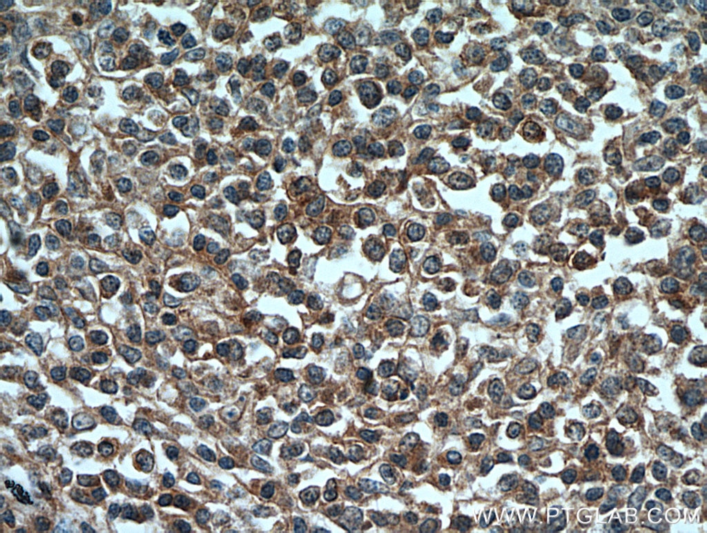 IHC staining of human lymphoma using 21120-1-AP