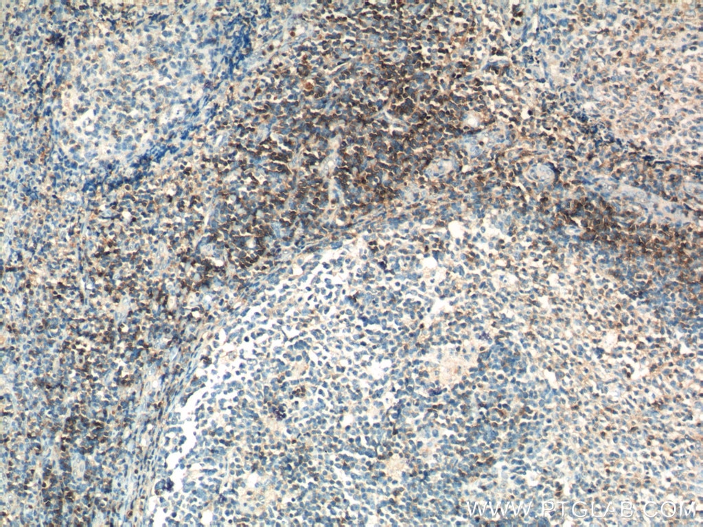 Immunohistochemistry (IHC) staining of human tonsillitis tissue using CD3 Gamma Monoclonal antibody (60347-1-Ig)