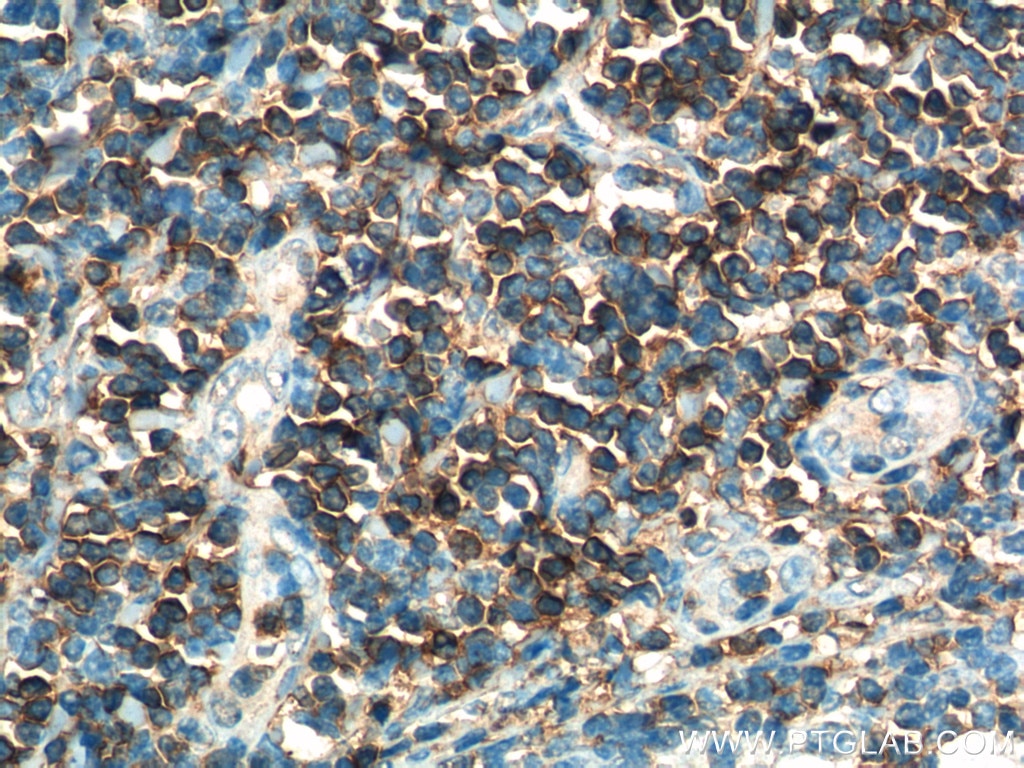 Immunohistochemistry (IHC) staining of human tonsillitis tissue using CD3 Gamma Monoclonal antibody (60347-1-Ig)