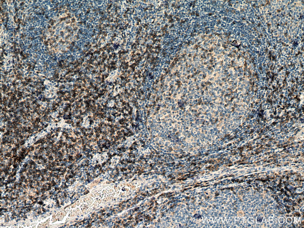 Immunohistochemistry (IHC) staining of human tonsillitis tissue using CD4 Monoclonal antibody (67786-1-Ig)