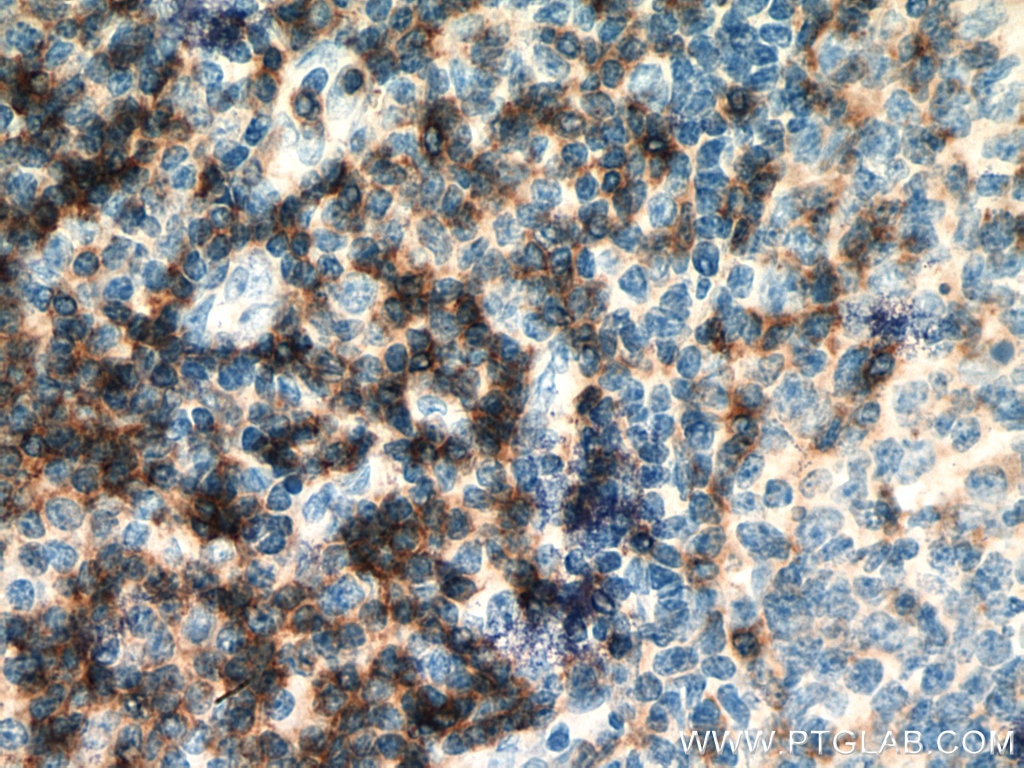 Immunohistochemistry (IHC) staining of human tonsillitis tissue using CD4 Monoclonal antibody (67786-1-Ig)