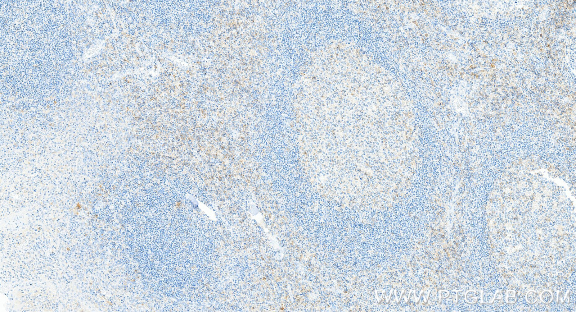 Immunohistochemistry (IHC) staining of human tonsillitis tissue using CD4 Recombinant monoclonal antibody (83513-10-RR)