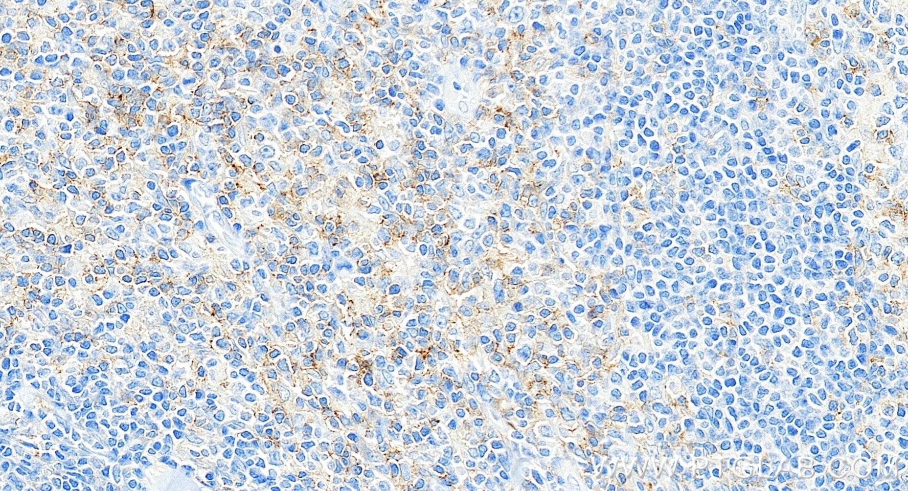 Immunohistochemistry (IHC) staining of human tonsillitis tissue using CD4 Recombinant monoclonal antibody (83513-10-RR)