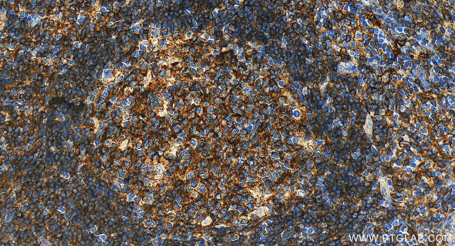 Immunohistochemistry (IHC) staining of human tonsillitis tissue using CD40 Polyclonal antibody (28158-1-AP)
