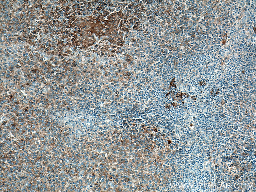 Immunohistochemistry (IHC) staining of human lymphoma tissue using CD40 Monoclonal antibody (66965-1-Ig)