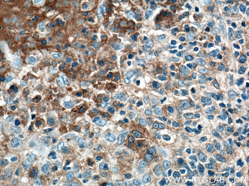 Immunohistochemistry (IHC) staining of human lymphoma tissue using CD40 Monoclonal antibody (66965-1-Ig)