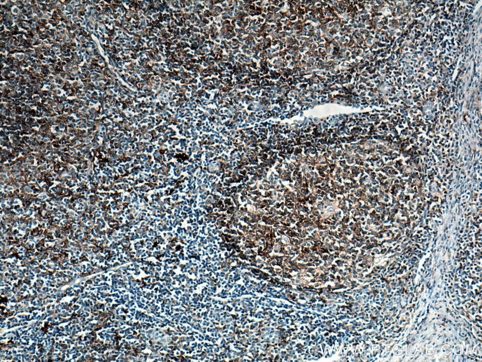 Immunohistochemistry (IHC) staining of human tonsillitis tissue using CD40 Monoclonal antibody (66965-1-Ig)