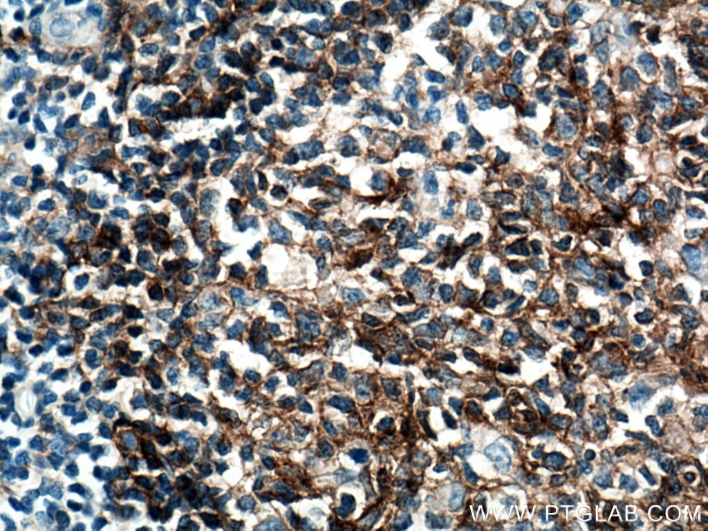 Immunohistochemistry (IHC) staining of human tonsillitis tissue using CD40 Monoclonal antibody (66965-1-Ig)