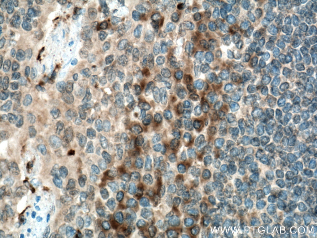 Immunohistochemistry (IHC) staining of human tonsillitis tissue using Biotin-conjugated CD40L/CD154 Monoclonal antibody (Biotin-66502)