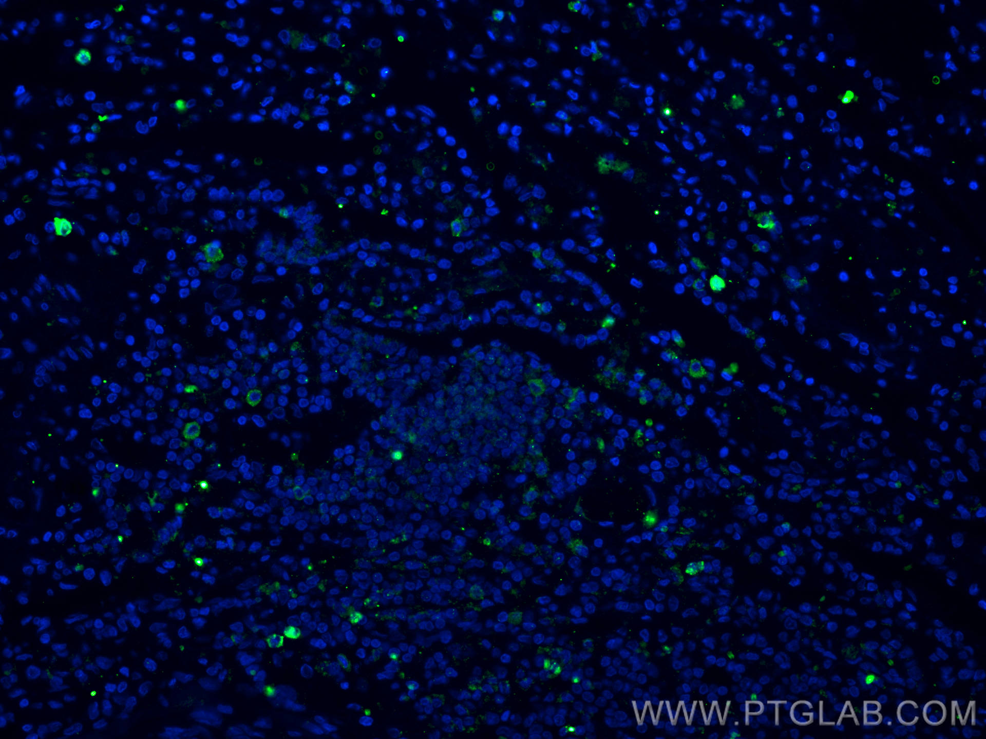 Immunofluorescence (IF) / fluorescent staining of human lung cancer tissue using CD40L/CD154 Polyclonal antibody (16668-1-AP)