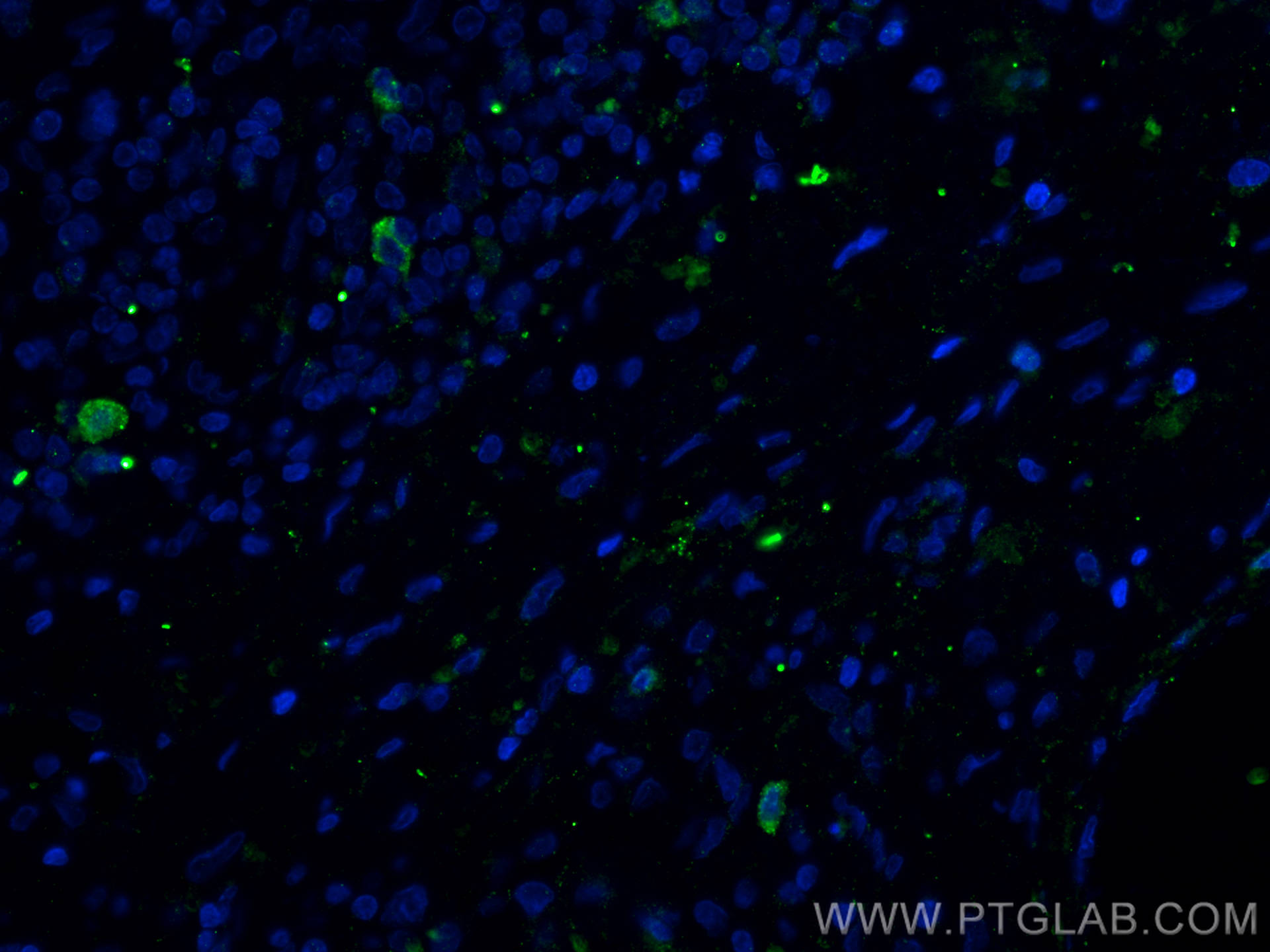 Immunofluorescence (IF) / fluorescent staining of human lung cancer tissue using CD40L/CD154 Polyclonal antibody (16668-1-AP)