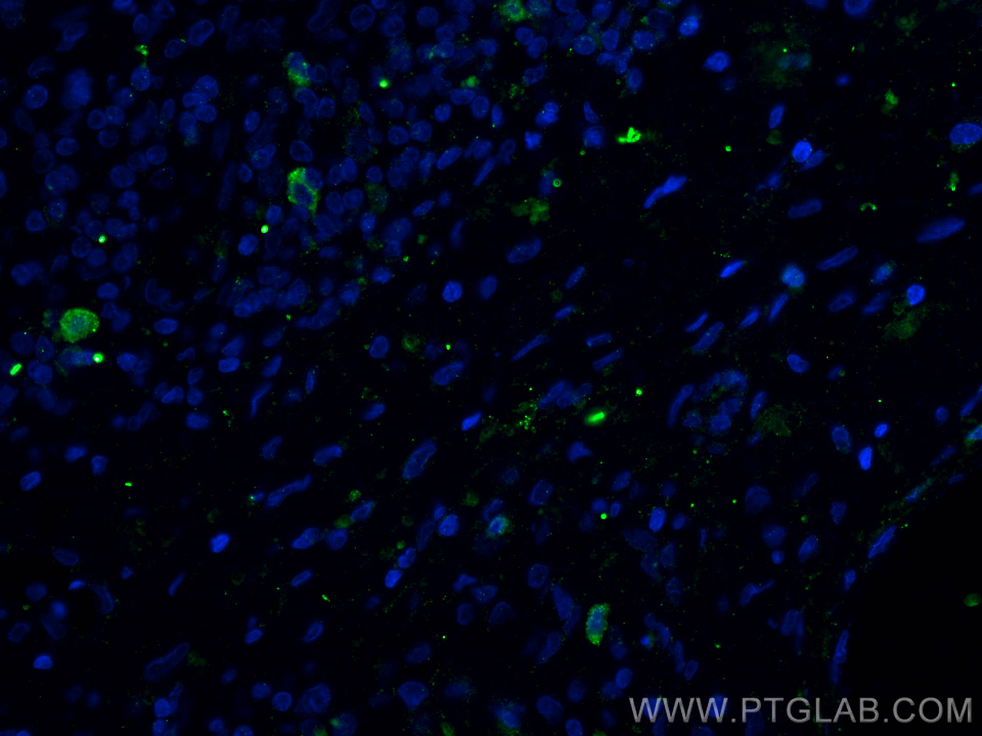 IF Staining of human lung cancer using 16668-1-AP