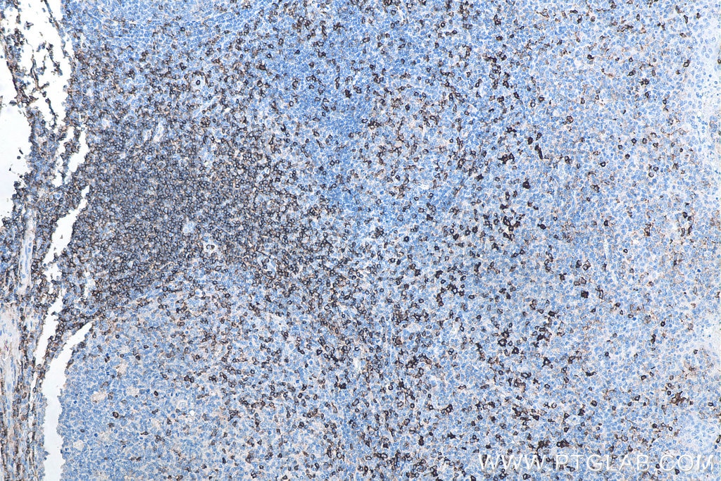 IHC staining of human tonsillitis using 66224-1-Ig