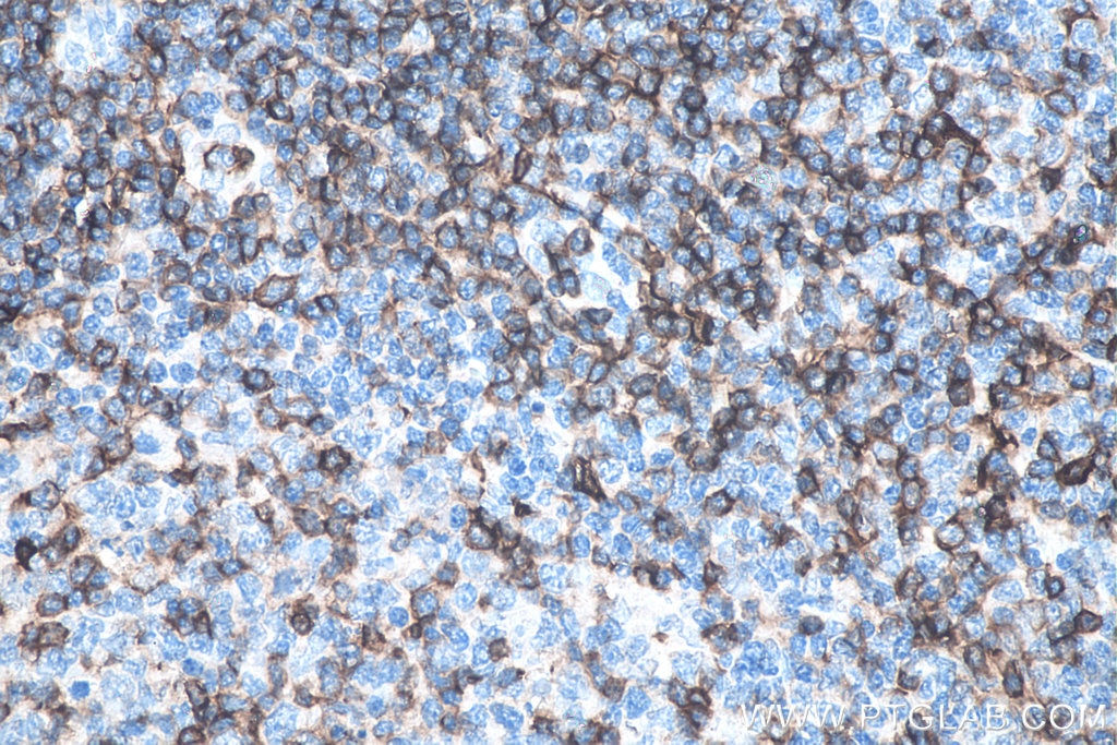 Immunohistochemistry (IHC) staining of human tonsillitis tissue using CD43 Monoclonal antibody (66224-1-Ig)