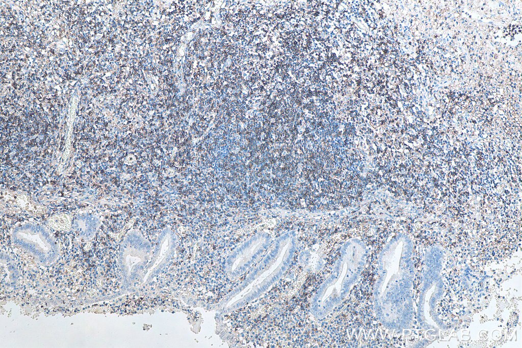 Immunohistochemistry (IHC) staining of human appendicitis tissue using CD43 Monoclonal antibody (66224-1-Ig)