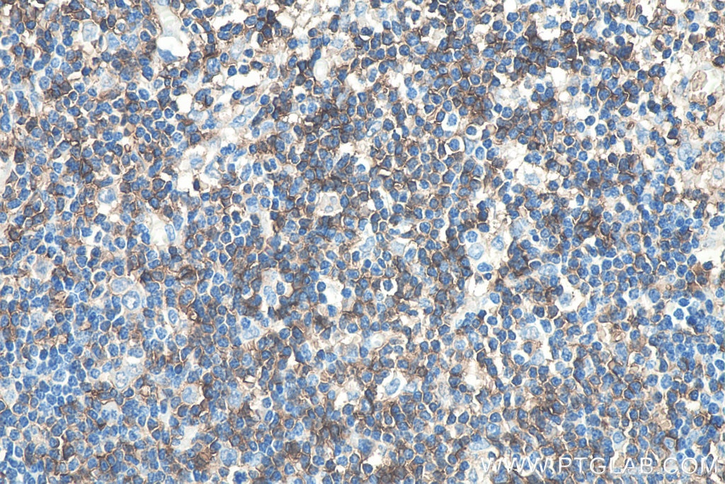Immunohistochemistry (IHC) staining of human appendicitis tissue using CD43 Monoclonal antibody (66224-1-Ig)