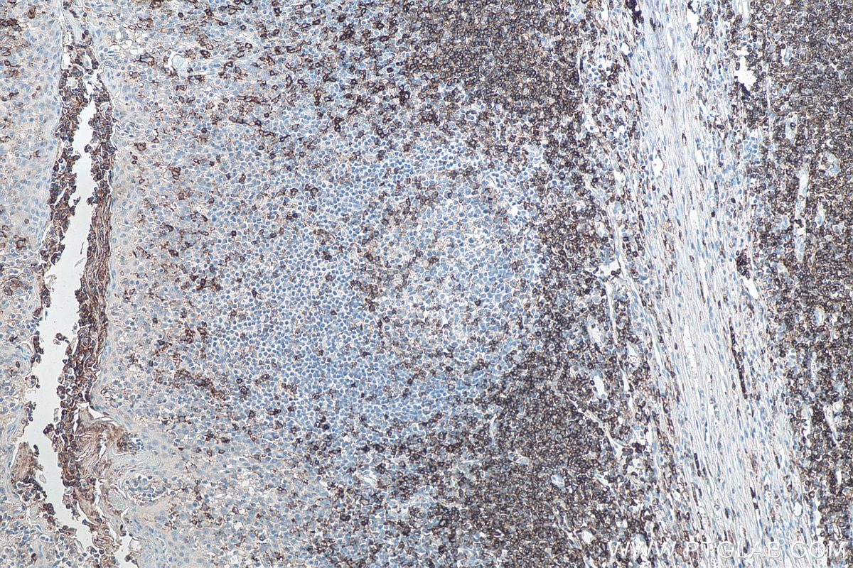 Immunohistochemistry (IHC) staining of human tonsillitis tissue using CD43 Monoclonal antibody (66224-1-Ig)