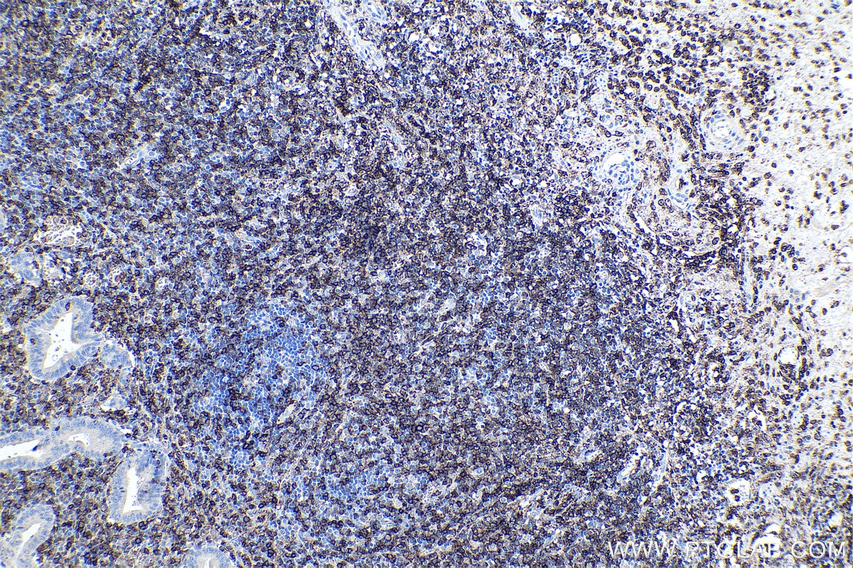 Immunohistochemistry (IHC) staining of human appendicitis tissue using CD43 Monoclonal antibody (66224-1-Ig)