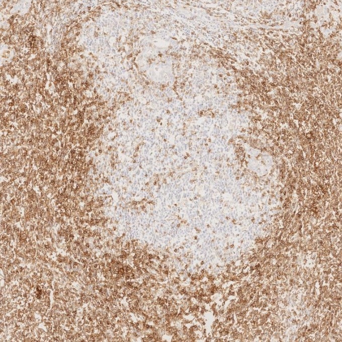 Immunohistochemistry (IHC) staining of human lymphoma tissue using CD43 Monoclonal antibody (66224-1-Ig)