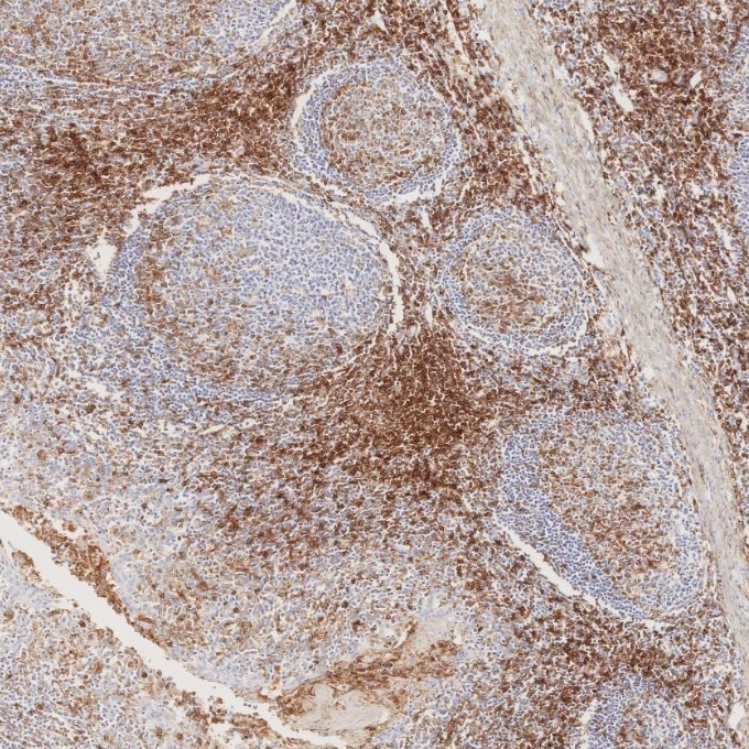Immunohistochemistry (IHC) staining of human tonsillitis tissue using CD43 Monoclonal antibody (66224-1-Ig)
