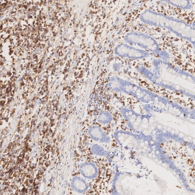 Immunohistochemistry (IHC) staining of human lymphoma tissue using CD43 Monoclonal antibody (66224-1-Ig)