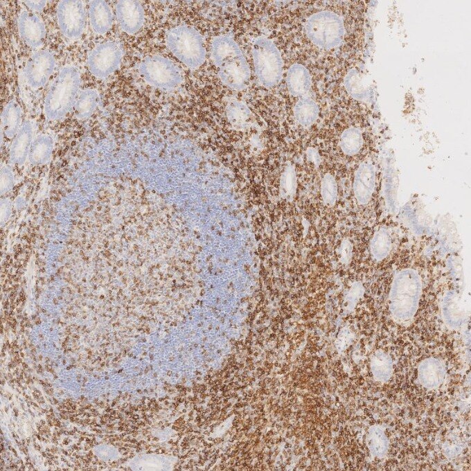Immunohistochemistry (IHC) staining of human appendicitis tissue using CD43 Monoclonal antibody (66224-1-Ig)