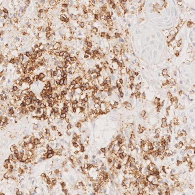Immunohistochemistry (IHC) staining of human lymphoma tissue using CD43 Monoclonal antibody (66224-1-Ig)
