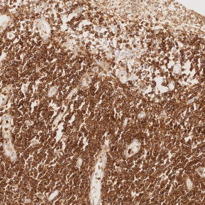 Immunohistochemistry (IHC) staining of human lymphoma tissue using CD43 Monoclonal antibody (66224-1-Ig)