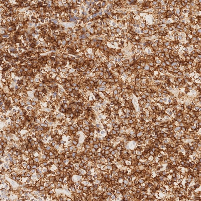 Immunohistochemistry (IHC) staining of human lymphoma tissue using CD43 Monoclonal antibody (66224-1-Ig)