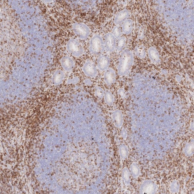 Immunohistochemistry (IHC) staining of human appendicitis tissue using CD43 Monoclonal antibody (66224-1-Ig)