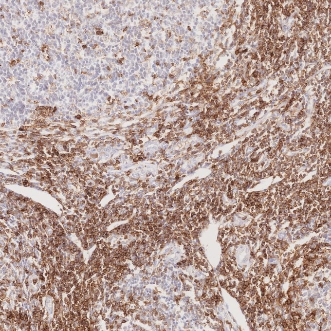 Immunohistochemistry (IHC) staining of human lymphoma tissue using CD43 Monoclonal antibody (66224-1-Ig)