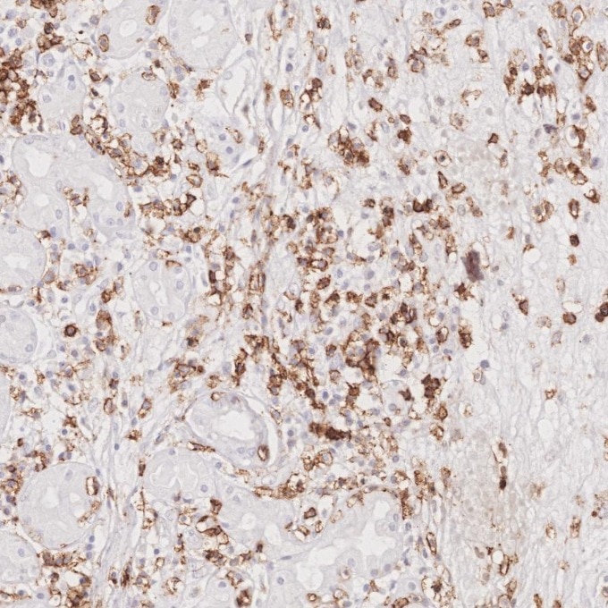 Immunohistochemistry (IHC) staining of human lymphoma tissue using CD43 Monoclonal antibody (66224-1-Ig)
