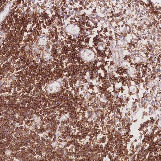 Immunohistochemistry (IHC) staining of human lymphoma tissue using CD43 Monoclonal antibody (66224-1-Ig)