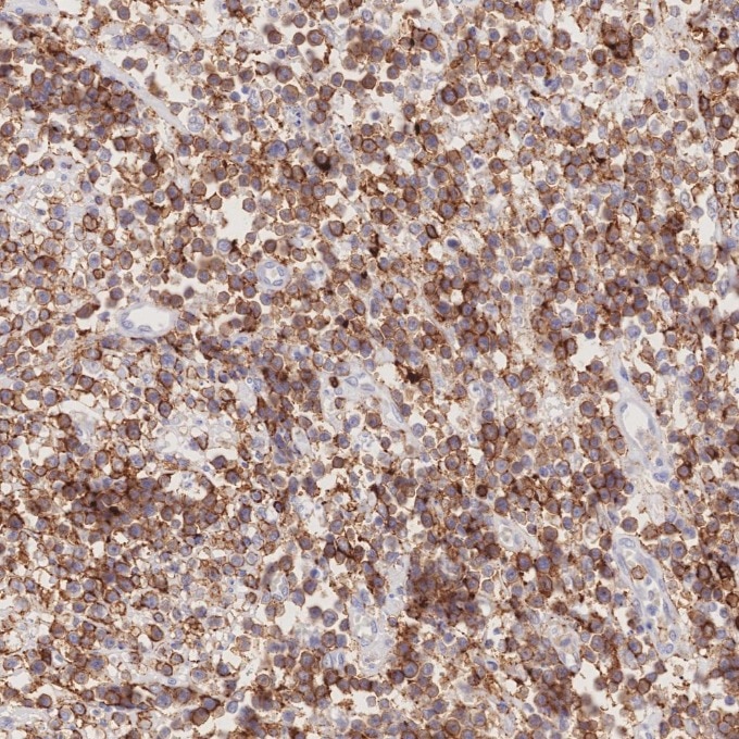 Immunohistochemistry (IHC) staining of human lymphoma tissue using CD43 Monoclonal antibody (66224-1-Ig)