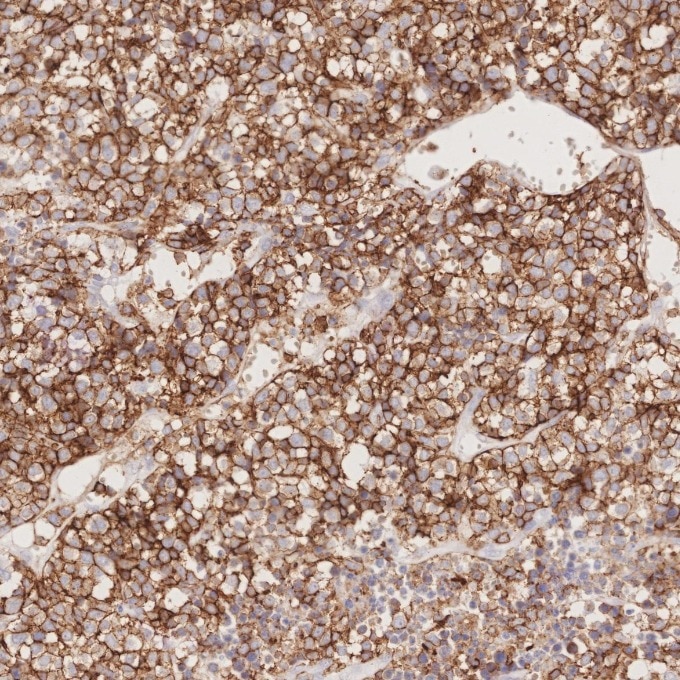 Immunohistochemistry (IHC) staining of human lymphoma tissue using CD43 Monoclonal antibody (66224-1-Ig)
