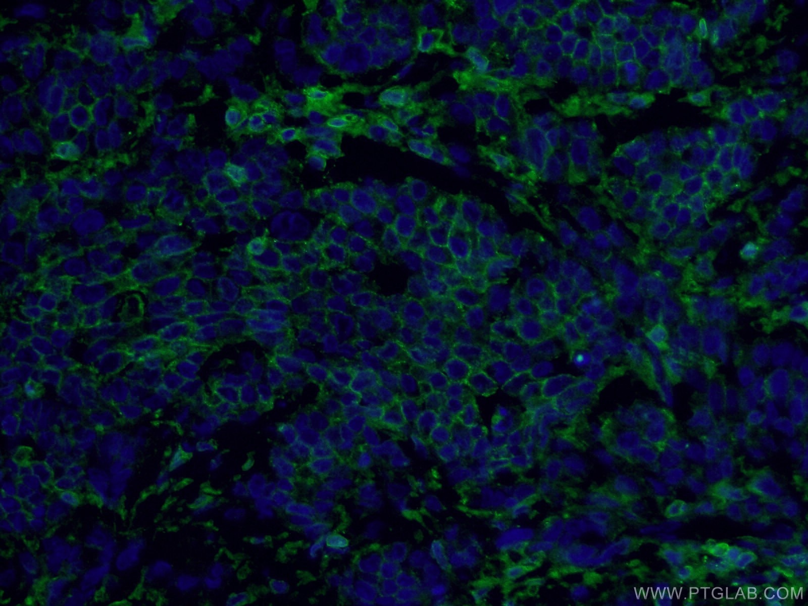 Immunofluorescence (IF) / fluorescent staining of human colon cancer tissue using CD44 Polyclonal antibody (15675-1-AP)
