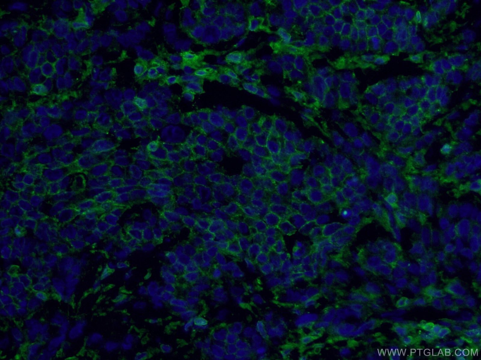 IF Staining of human colon cancer using 15675-1-AP