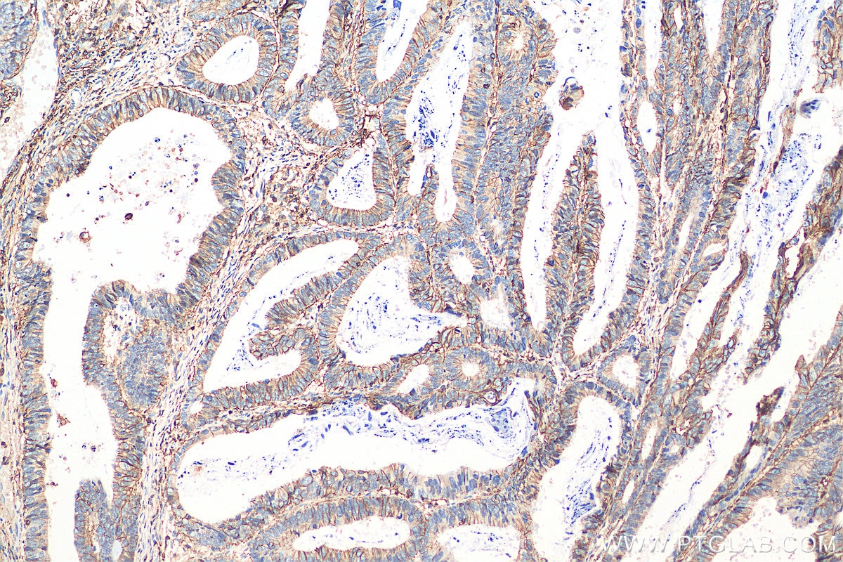 IHC staining of human colon cancer using 15675-1-AP