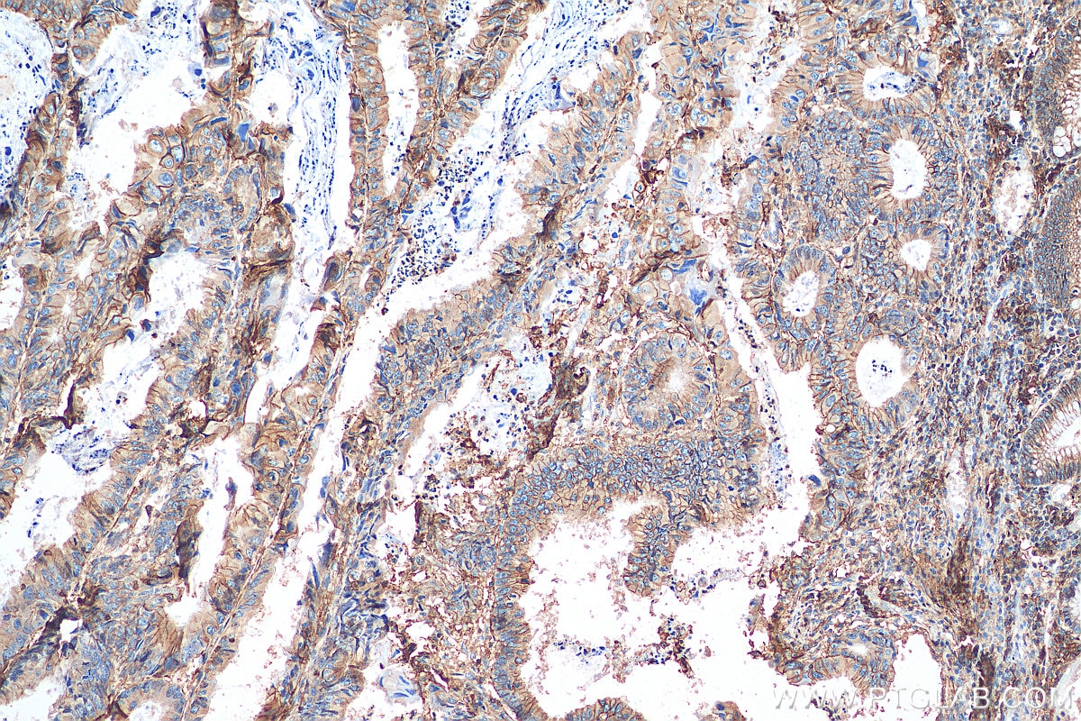 Immunohistochemistry (IHC) staining of human colon cancer tissue using CD44 Polyclonal antibody (15675-1-AP)