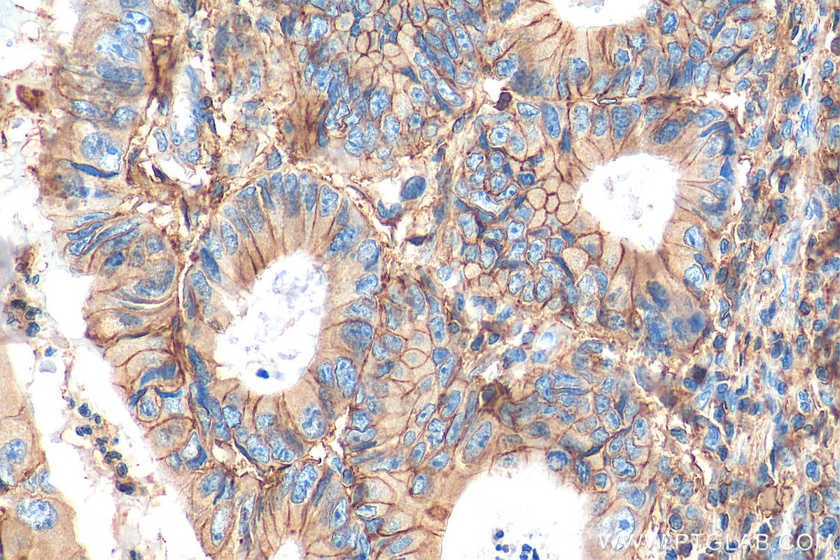 Immunohistochemistry (IHC) staining of human colon cancer tissue using CD44 Polyclonal antibody (15675-1-AP)