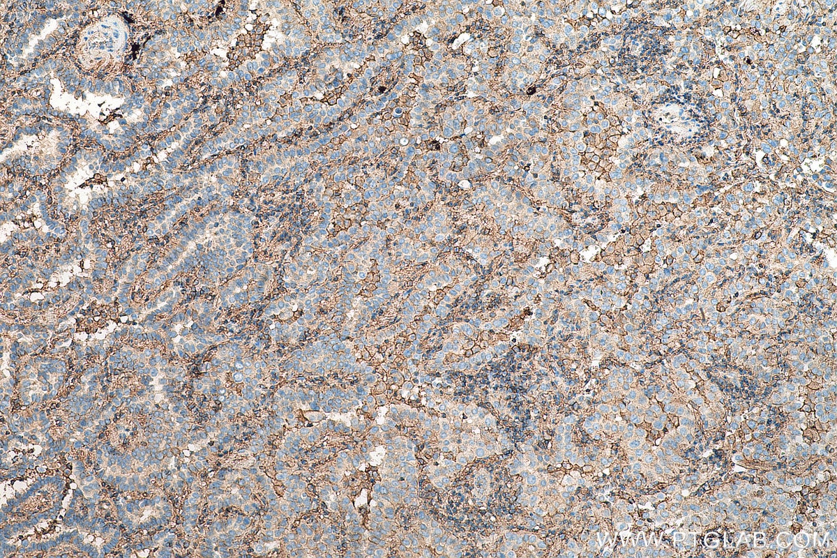 Immunohistochemistry (IHC) staining of human lung cancer tissue using CD44 Polyclonal antibody (15675-1-AP)