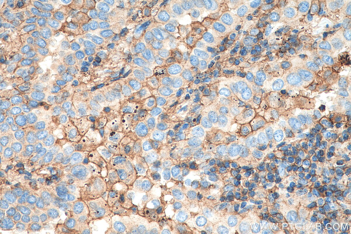 Immunohistochemistry (IHC) staining of human lung cancer tissue using CD44 Polyclonal antibody (15675-1-AP)