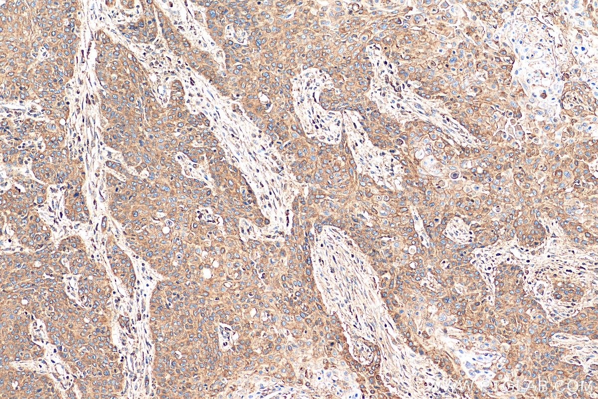 Immunohistochemistry (IHC) staining of human oesophagus cancer tissue using CD44 Polyclonal antibody (15675-1-AP)