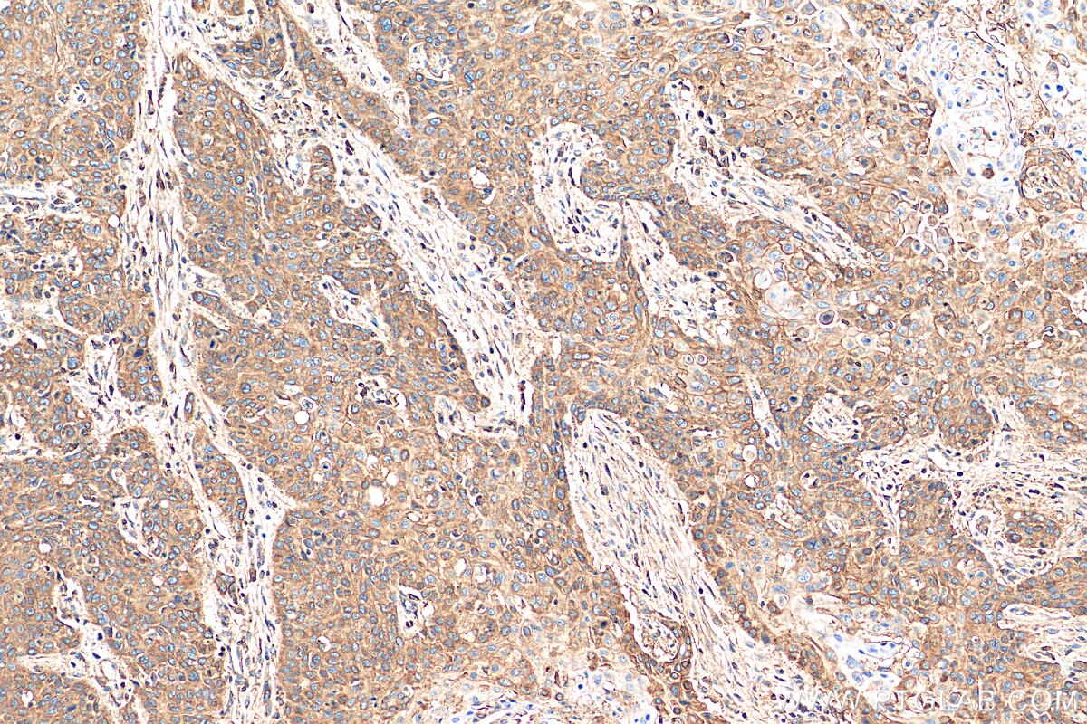 IHC staining of human oesophagus cancer using 15675-1-AP