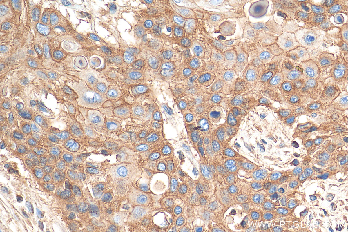 Immunohistochemistry (IHC) staining of human oesophagus cancer tissue using CD44 Polyclonal antibody (15675-1-AP)